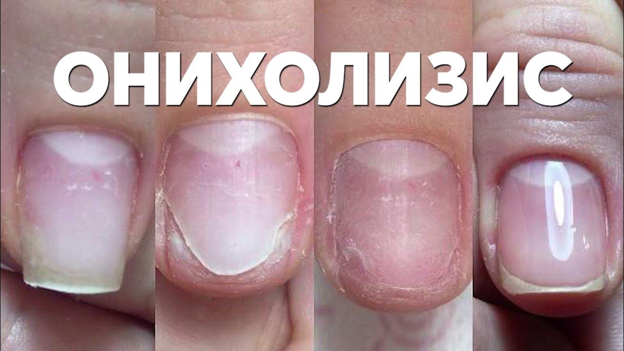 Онихолизис