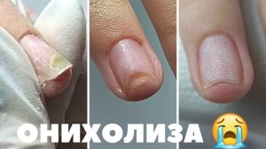 Онихолиза
